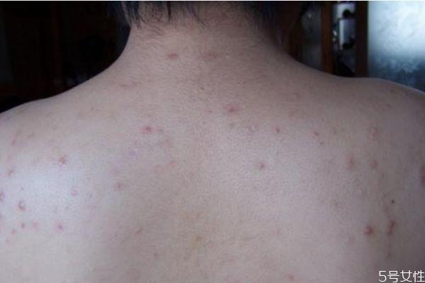 背上的痘痘应该怎么去除 背上的痘痘应该怎么去除