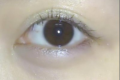 ​黑眼圈有哪几种类型