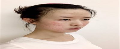 ​如何把痘痘彻底治好
